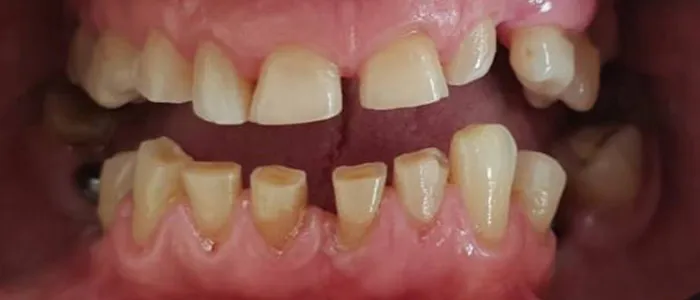 Protezy zębowe
