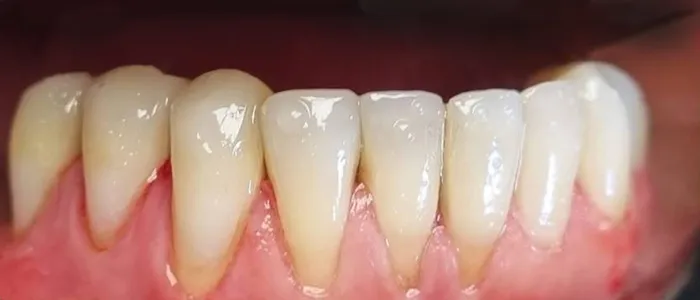 Protezy zębowe